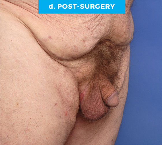 BURIED/HIDDEN PENIS CORRECTIVE SURGERY Patient 10 After 2