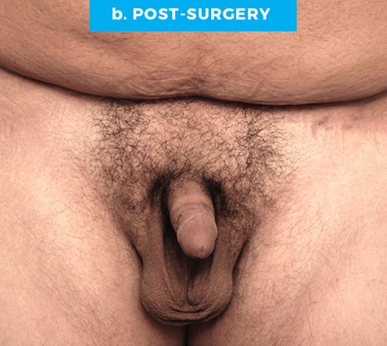 BURIED/HIDDEN PENIS CORRECTIVE SURGERY Patient 11 After