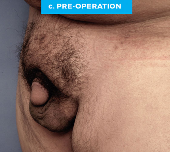 BURIED/HIDDEN PENIS CORRECTIVE SURGERY Patient 11 Before 2