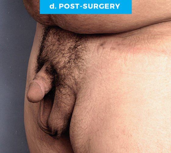BURIED/HIDDEN PENIS CORRECTIVE SURGERY Patient 11 After 2
