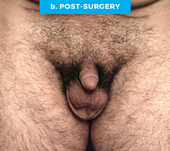 BURIED/HIDDEN PENIS CORRECTIVE SURGERY Patient 17 After