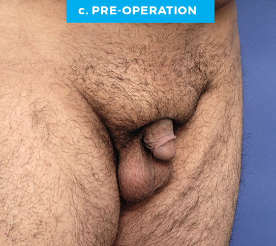 BURIED/HIDDEN PENIS CORRECTIVE SURGERY Patient 17 Before 2