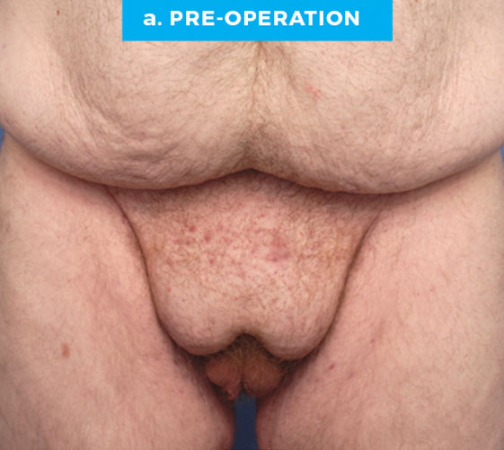 BURIED/HIDDEN PENIS CORRECTIVE SURGERY Patient 18 Before