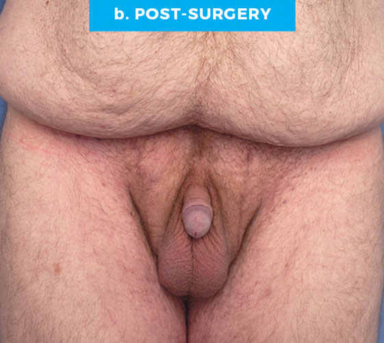 BURIED/HIDDEN PENIS CORRECTIVE SURGERY Patient 18 After