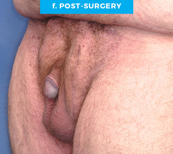 BURIED/HIDDEN PENIS CORRECTIVE SURGERY Patient 18 After