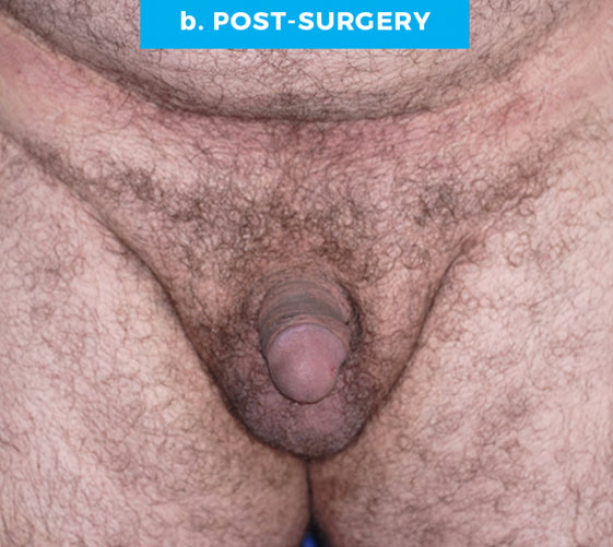 BURIED/HIDDEN PENIS CORRECTIVE SURGERY Patient 19 After