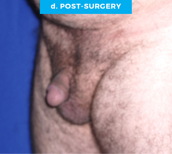 BURIED/HIDDEN PENIS CORRECTIVE SURGERY Patient 19 After 2