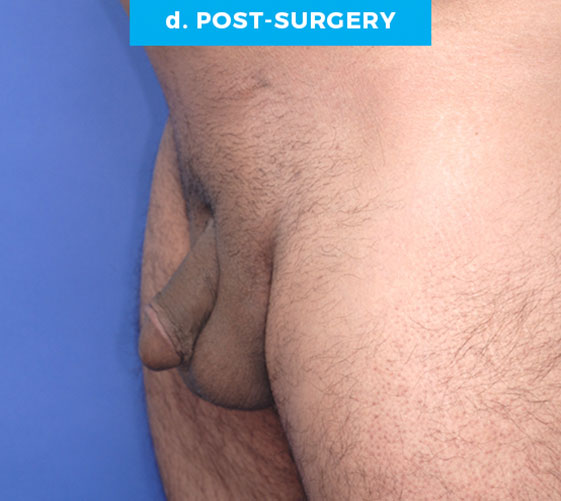 BURIED/HIDDEN PENIS CORRECTIVE SURGERY Patient 20 After 2