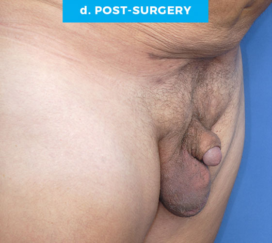 BURIED/HIDDEN PENIS CORRECTIVE SURGERY Patient 22 After 2