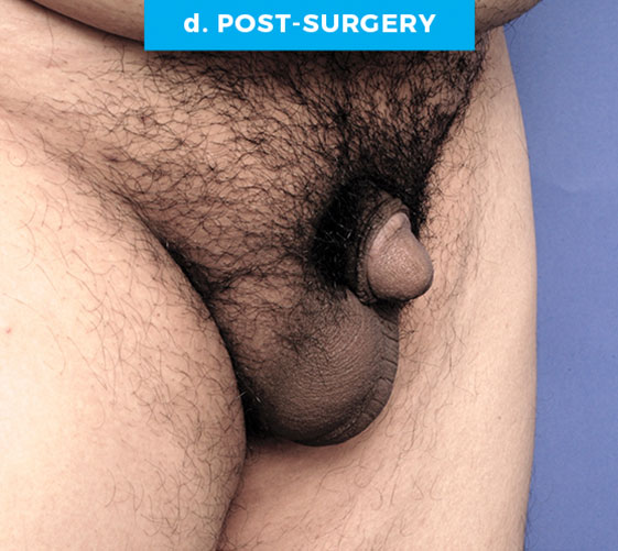 BURIED/HIDDEN PENIS CORRECTIVE SURGERY Patient 6 After 2