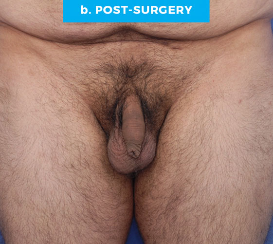BURIED/HIDDEN PENIS CORRECTIVE SURGERY Patient 8 After