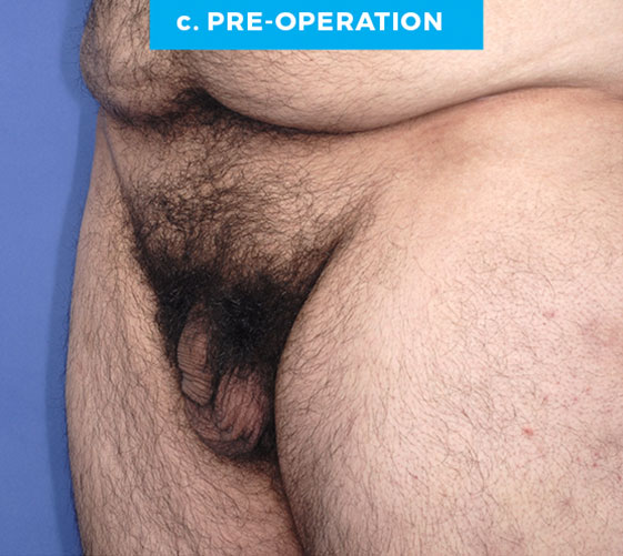 BURIED/HIDDEN PENIS CORRECTIVE SURGERY Patient 8 Before 2