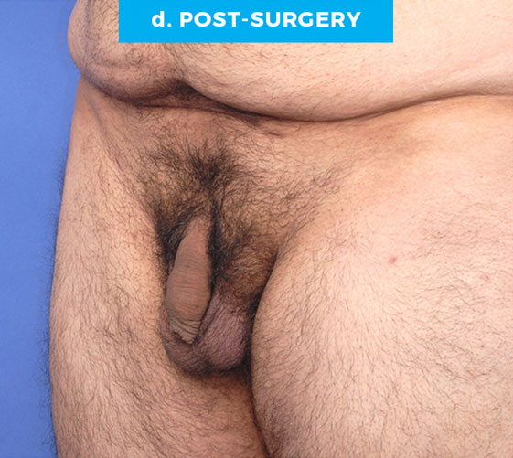 BURIED/HIDDEN PENIS CORRECTIVE SURGERY Patient 8 After 2