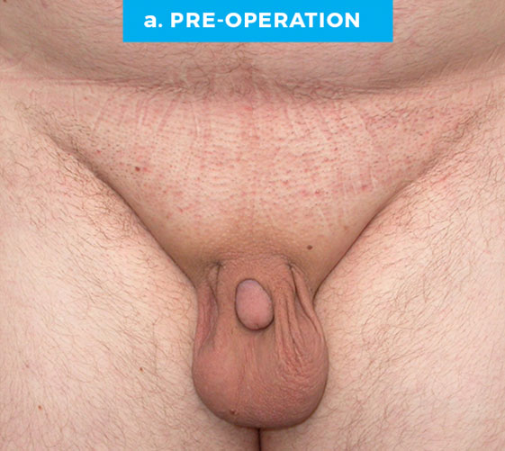 BURIED/HIDDEN PENIS CORRECTIVE SURGERY Patient 9 Before