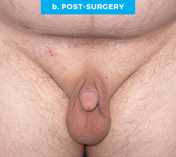 BURIED/HIDDEN PENIS CORRECTIVE SURGERY Patient 9 After