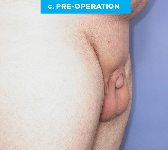 BURIED/HIDDEN PENIS CORRECTIVE SURGERY Patient 9 Before 2