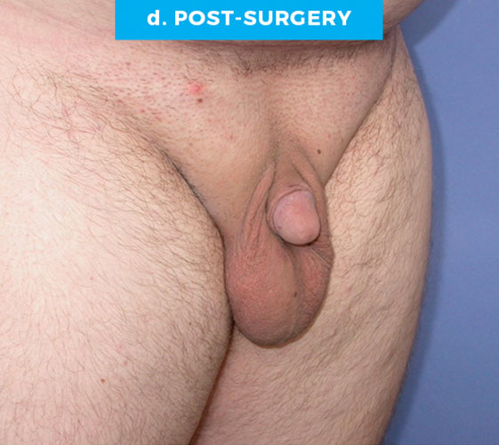 BURIED/HIDDEN PENIS CORRECTIVE SURGERY Patient 9 After 2