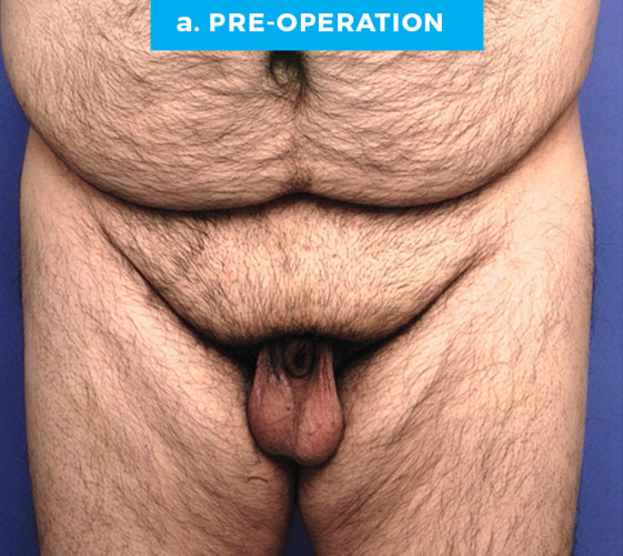 BURIED/HIDDEN PENIS CORRECTIVE SURGERY Patient 15 Before