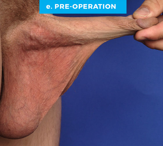 SCROTUM REDUCTION Patient 2 Before 3