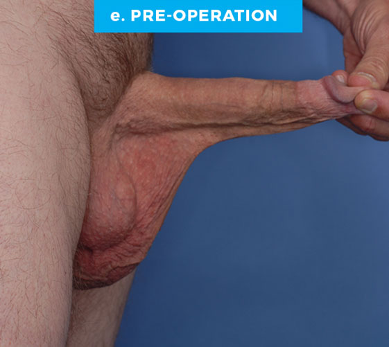 SCROTUM REDUCTION Patient 6 Before 3