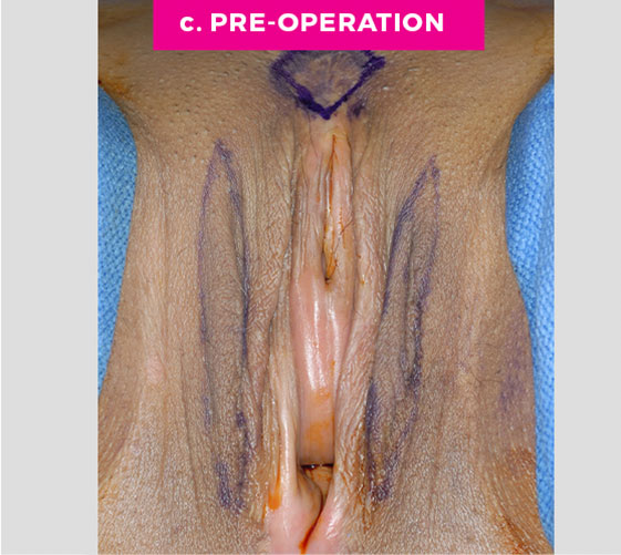 MALE-TO-FEMALE SEX REASSIGNMENT REVISIONS Patient 6 Before 2