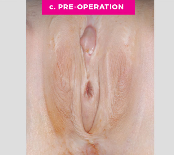 MALE-TO-FEMALE SEX REASSIGNMENT REVISIONS Patient 9 Before 2