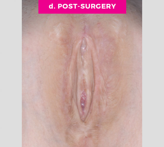 MALE-TO-FEMALE SEX REASSIGNMENT REVISIONS Patient 9 After 2