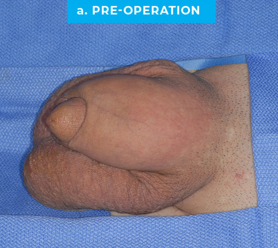 penis-enlarge-p5-a PENIS ENLARGEMENT RECONSTRUCTION Patient 5 Before
