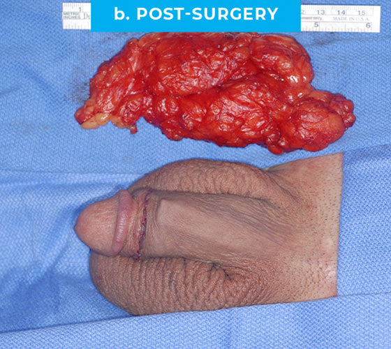 penis-enlarge-p5-b PENIS ENLARGEMENT RECONSTRUCTION Patient 5 Before 2