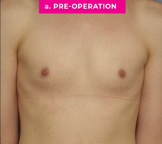 Gender Confirmation Breast Aug Patient 1 Before