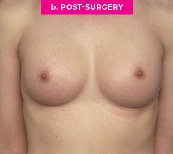 Gender Confirmation Breast Aug Patient 1 After