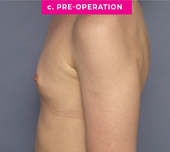 Gender Confirmation Breast Aug Patient 1 Before Side