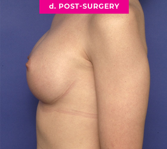 Gender Confirmation Breast Aug Patient 1 After Side