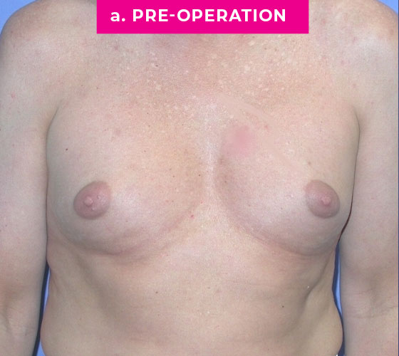 Gender Confirmation Breast Aug Patient 2 Before
