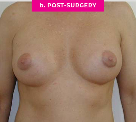 Gender Confirmation Breast Aug Patient 2 After