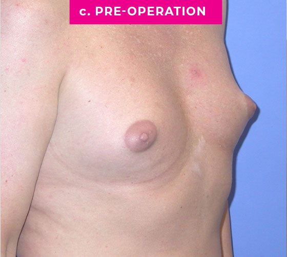 Gender Confirmation Breast Aug Patient 2 Before Side
