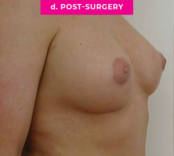 Gender Confirmation Breast Aug Patient 2 After Side