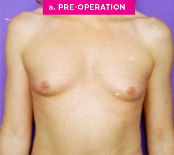 Gender Confirmation Breast Aug Patient 3 Before