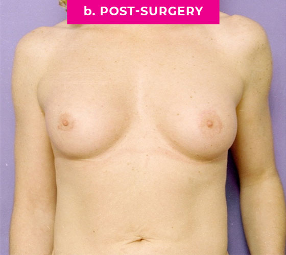 Gender Confirmation Breast Aug Patient 3 After