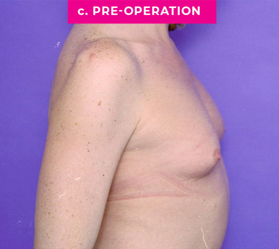 Gender Confirmation Breast Aug Patient 3 Before Side