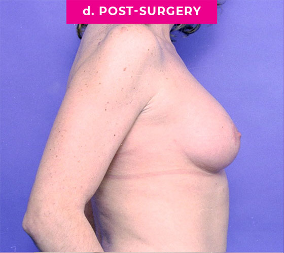 Gender Confirmation Breast Aug Patient 3 After Side