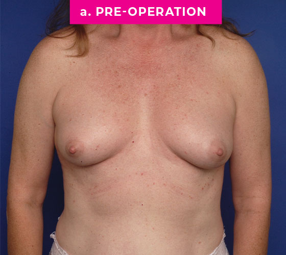 Gender Confirmation Breast Aug Patient 4 Before