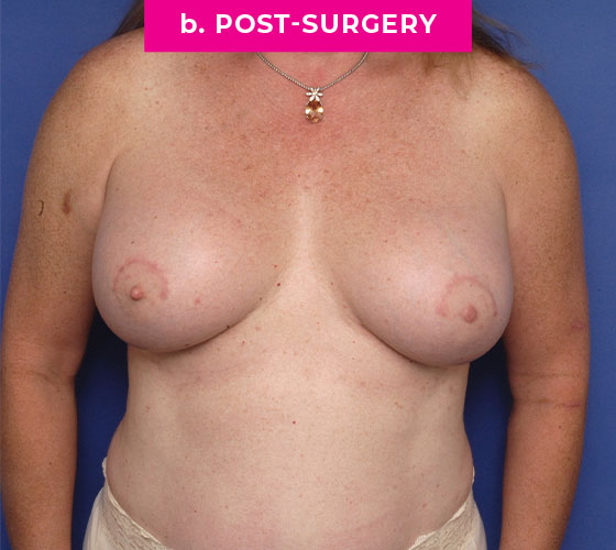 Gender Confirmation Breast Aug Patient 4 After