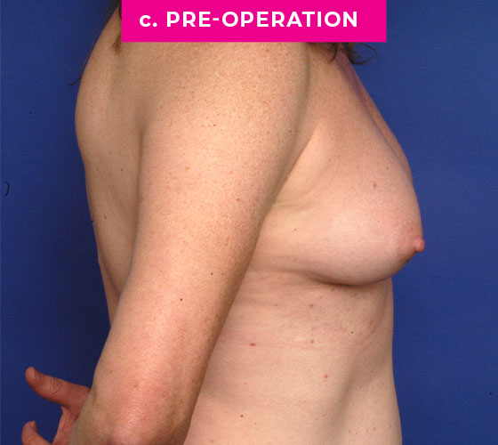 Gender Confirmation Breast Aug Patient 4 Before Side