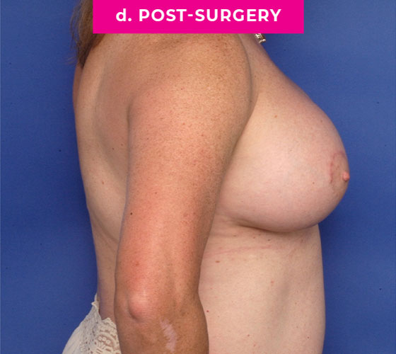 Gender Confirmation Breast Aug Patient 4 After Side