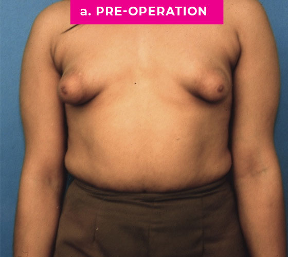 Gender Confirmation Breast Aug Patient 5 Before