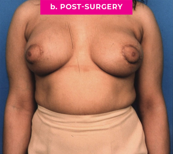 Gender Confirmation Breast Aug Patient 5 After