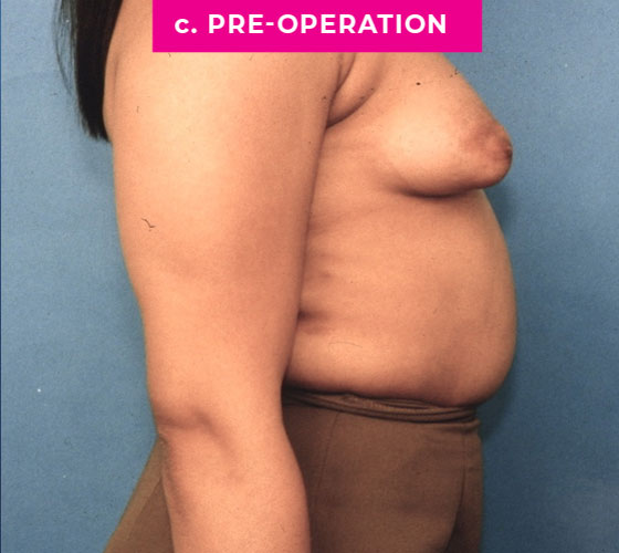 Gender Confirmation Breast Aug Patient 5 Before Side