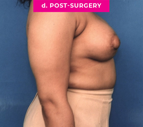 Gender Confirmation Breast Aug Patient 5 After Side