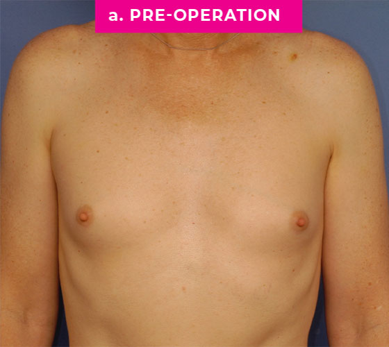 Gender Confirmation Breast Aug Patient 6 Before